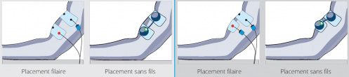 placement electrodes-tendinopathie du biceps